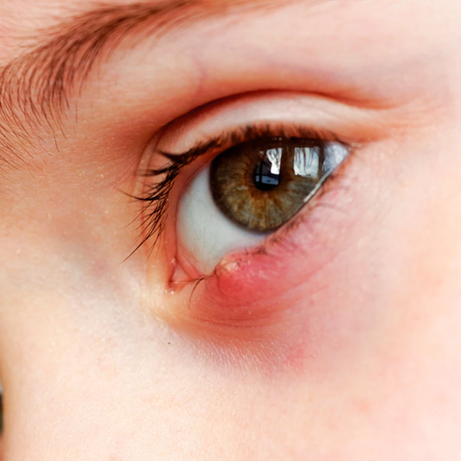 Terçol na criança: o que fazer?